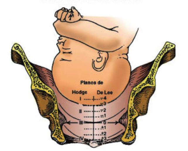 planos de Hodge partos negligencias
