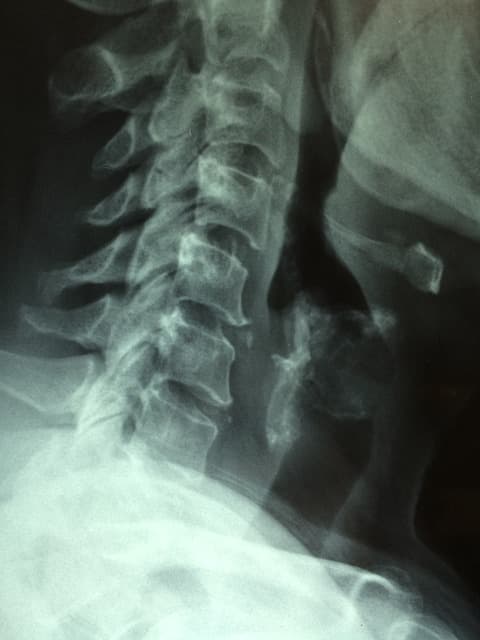 Lesión medular por negligencia médica