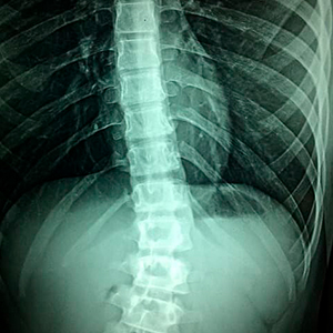 Tetraplejia por Negligencia Médica