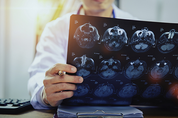 la emiplejia como lesión cerebral por negligencia médica