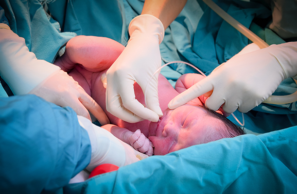 Asfixia Perinatal por Negligencia Médica