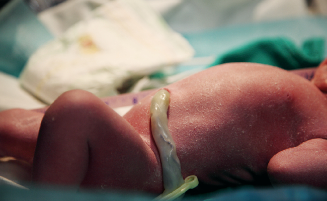 Prolapso del cordon umbilical