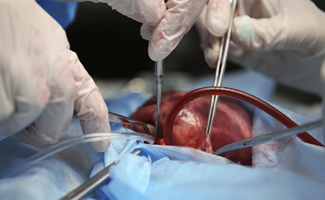 Endometritis por negligencia médica