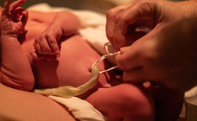 Prolapso del cordón umbilical por negligencia médica durante el parto
